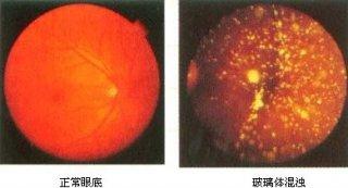 玻璃体混浊.jpg