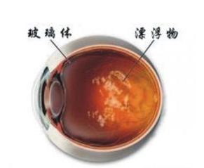 混浊1.png