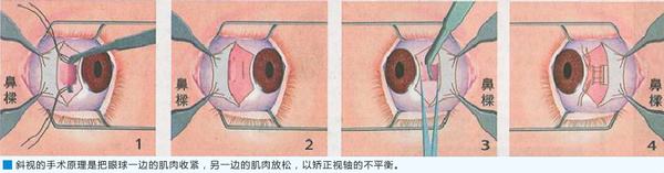 斜视手术.jpg