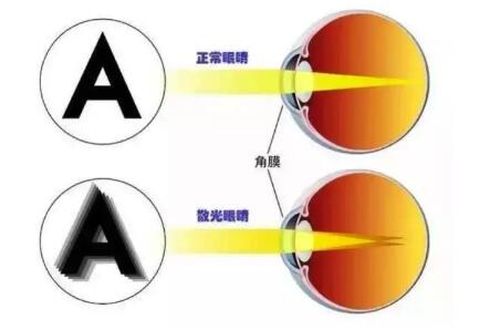 散光眼的表现 散光眼治疗.jpg