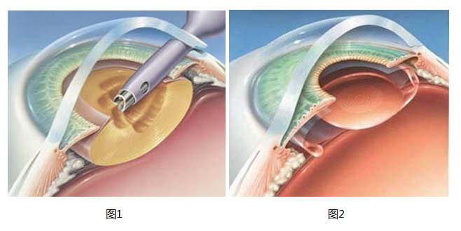 白内障手术过程1.png